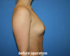 plastic-surgery-breast-augmentation